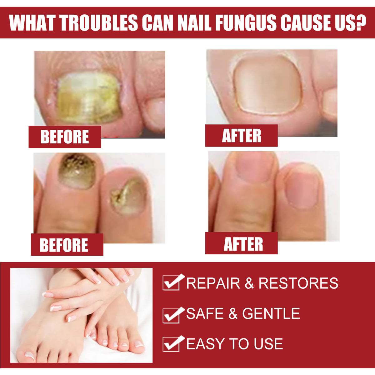 EELHOE Nail Repair Solution, Hands And Feet Nail Repair Moisturizing Clean And Remove Gray Nail Repair Solution